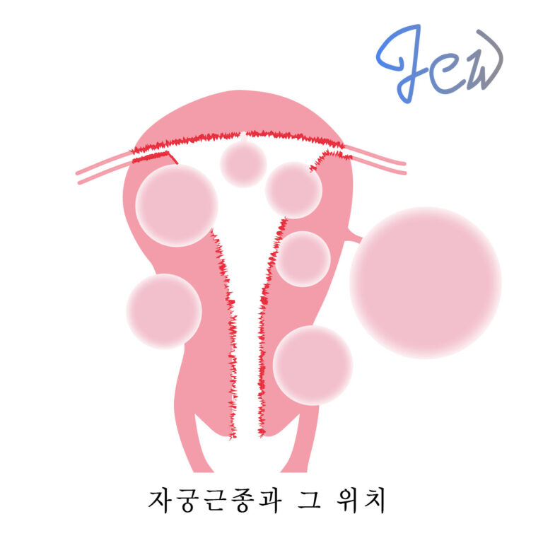 자궁근종들